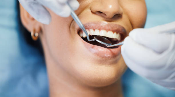 Best Emergency Dentist for Lost Fillings or Crowns in Yale, MI