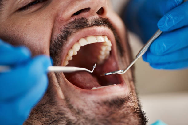 Best Emergency Dentist for Knocked-Out Tooth in Yale, MI